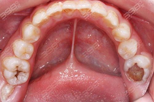 成人龋齿自测图解视频,轻松掌握口腔健康