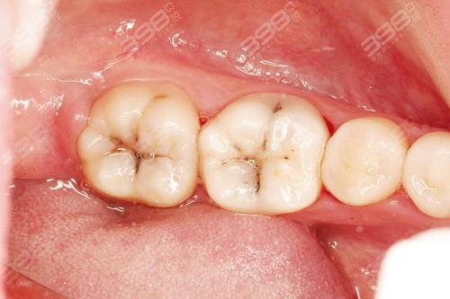 成人龋齿自测图解视频,轻松掌握口腔健康