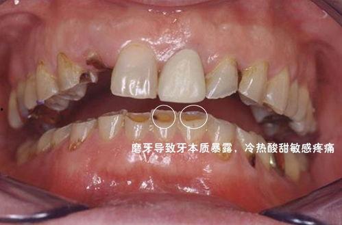 磨牙套成人佩戴视频讲解,轻松告别夜间磨牙困扰