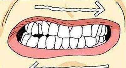 磨牙套成人佩戴视频讲解,轻松告别夜间磨牙困扰